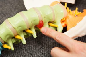 Doctor pointing out a herniated disc