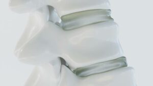 Spinal as close-up as 3D Rendering - herniated disc