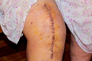 Image of a scar from a knee replacement surgery on an elderly woman.