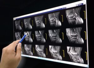 ACL specialist reviewing the Magnetic resonance (MRI) of right knee, Knee joint effusion, sagittal view.